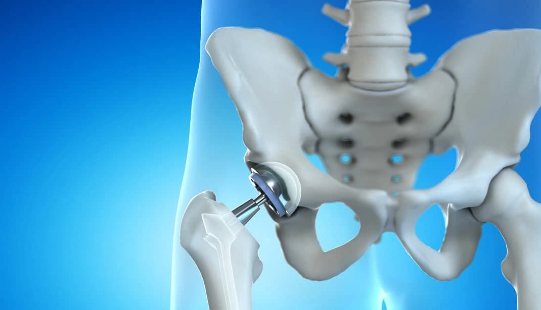 تبديل المفاصل